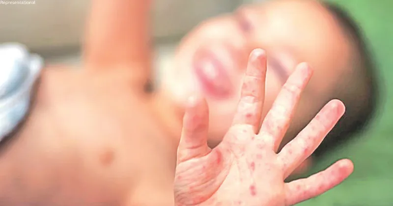 HFMD surge among kids in Jaisalmer
